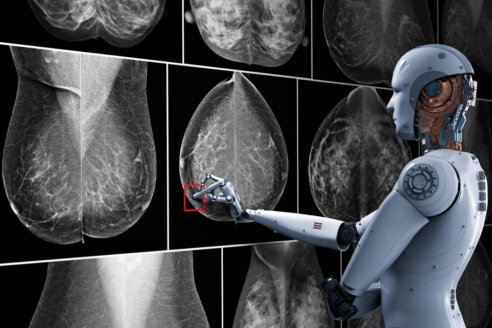Inteligência Artificial prevê câncer de mama com até 5 anos de antecedência