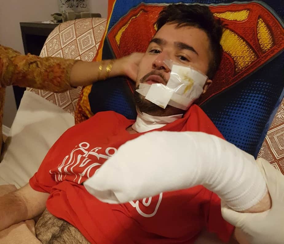 Celular explode e queima rosto e braço esquerdo de um homem no Canadá